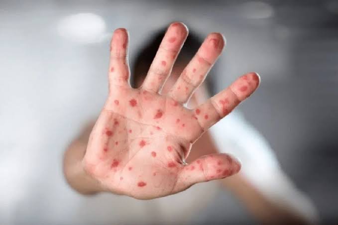 رفع حالة التأهب القاري لمرض جدري القردة